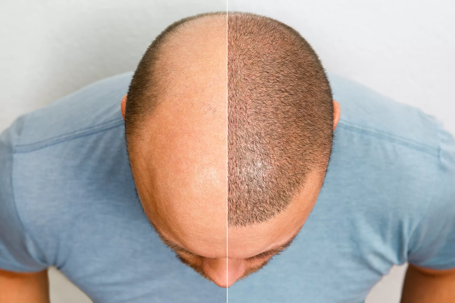 What is Hair Transplant